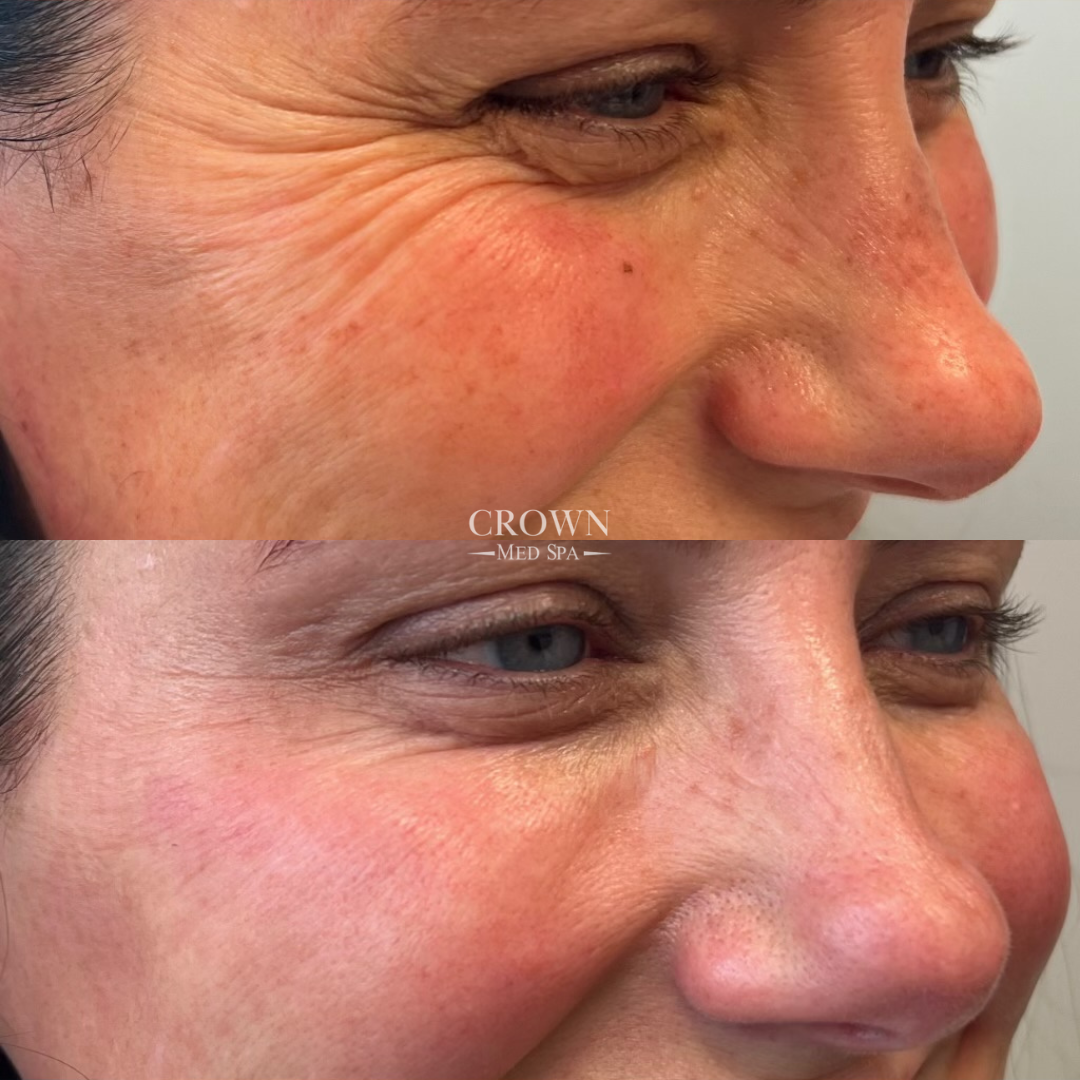 Before and after skin treatment comparison.