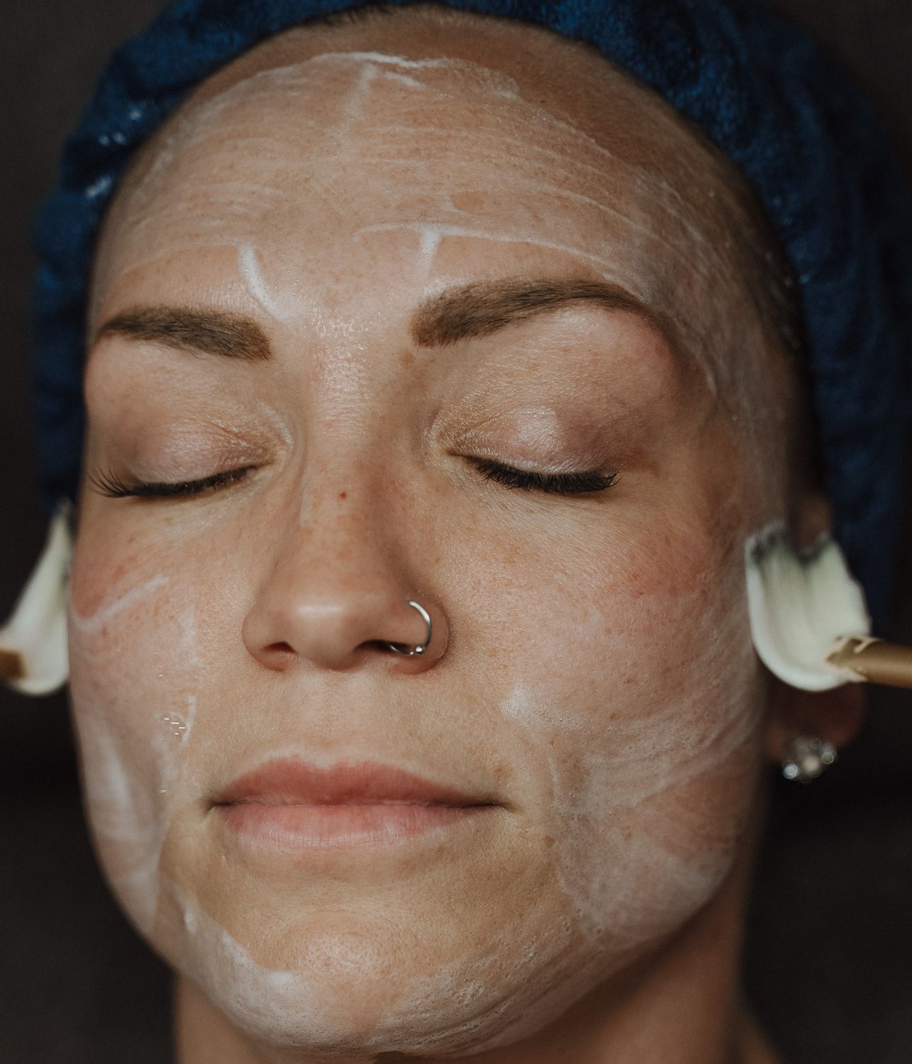 Crown Point Acne Facial model with brown hair