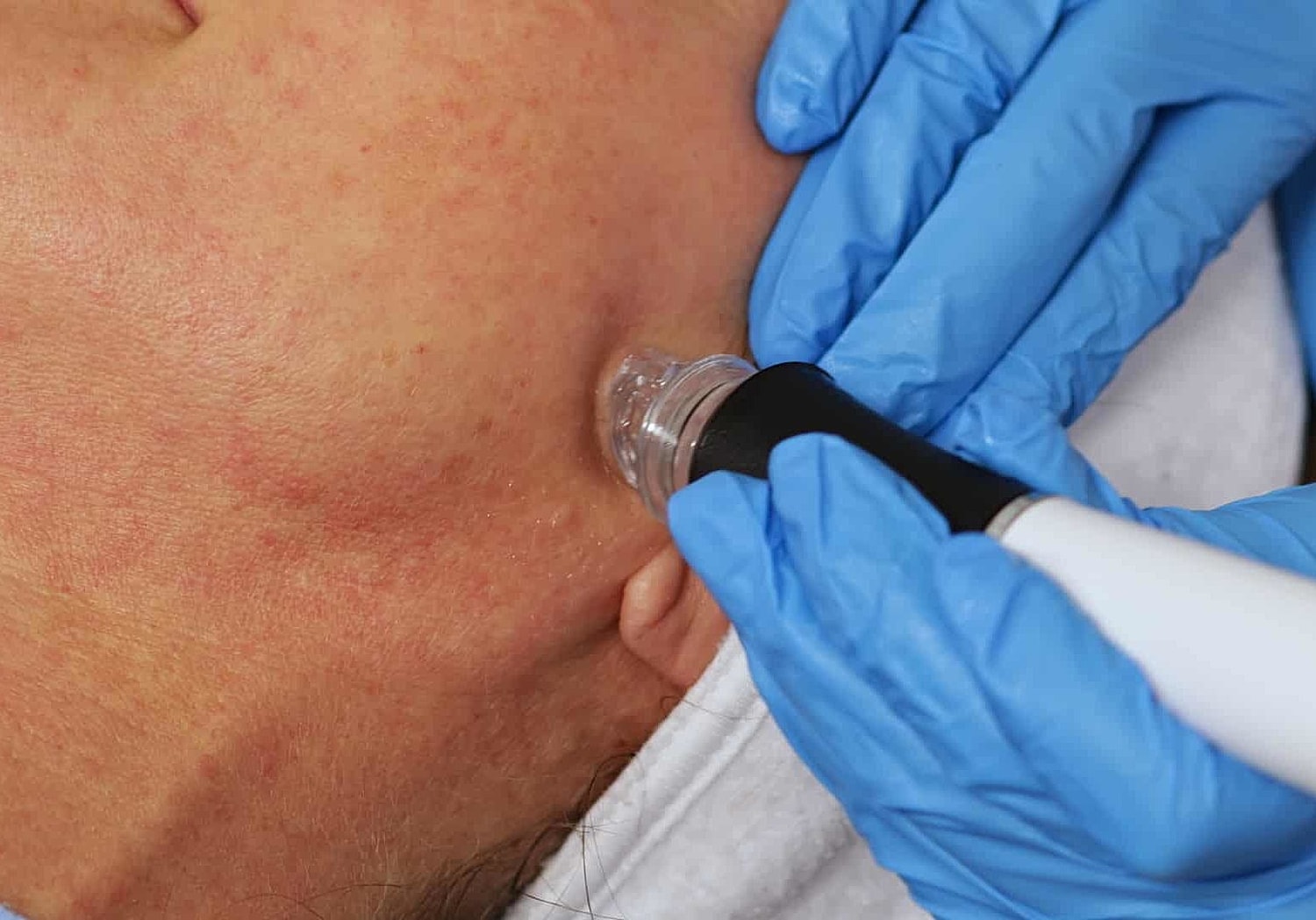 Patient receiving an AquaFirmeXS facial 