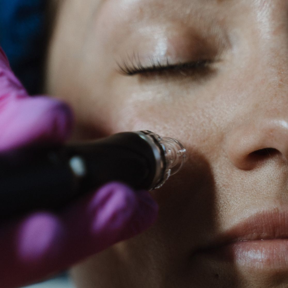 Crown Point Rosacea Treatment model with blonde hair