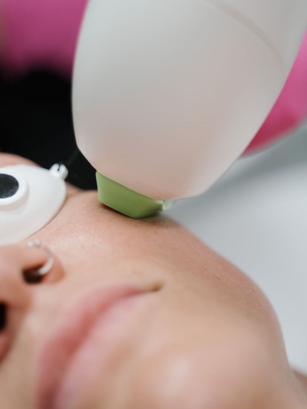 Crown Point Melasma Treatment model with blonde hair