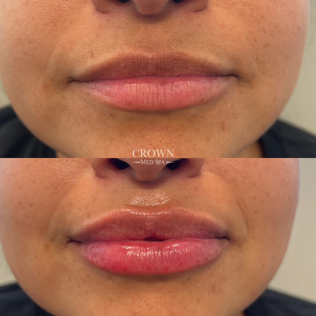 Dermal Fillers before & after