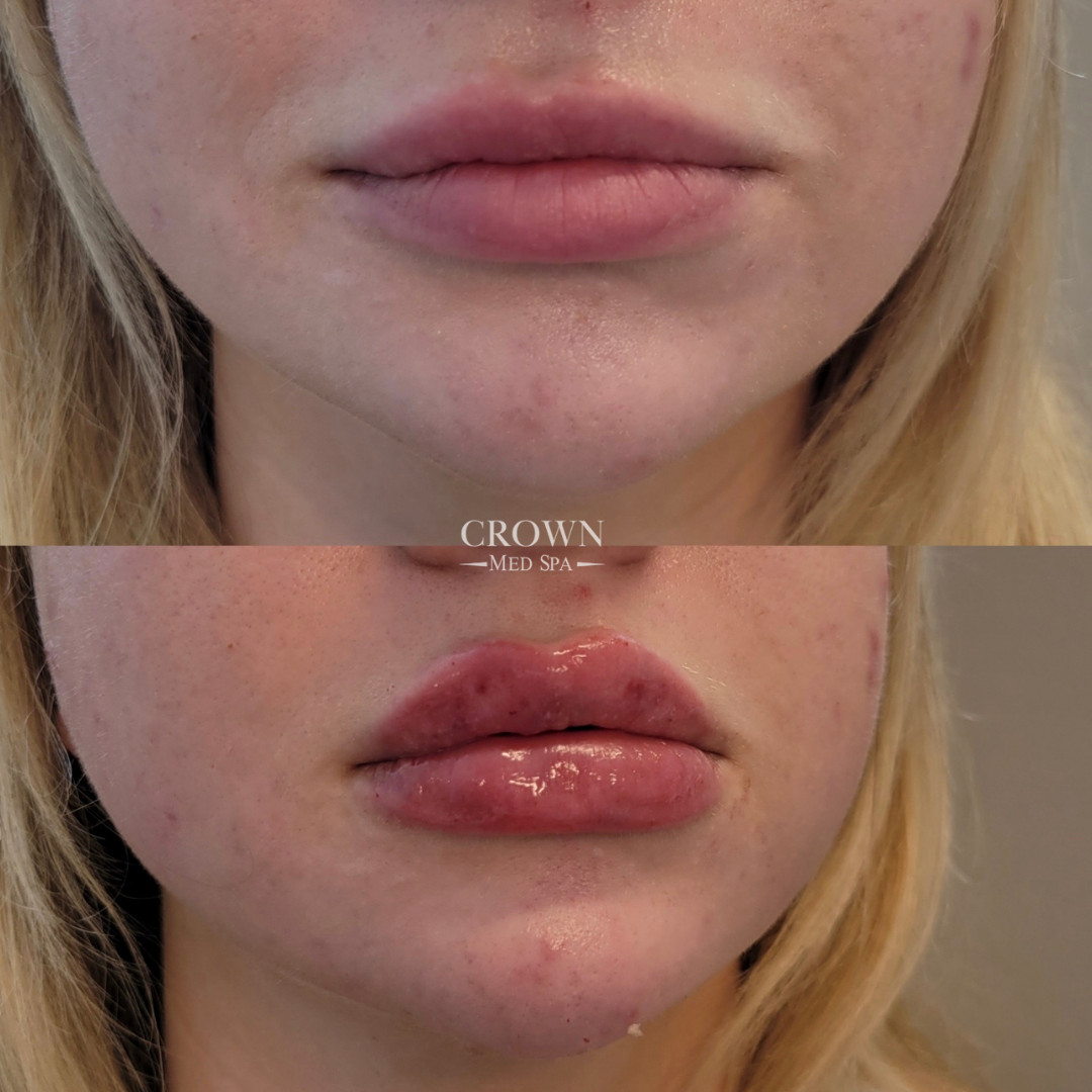 Dermal Fillers before & after