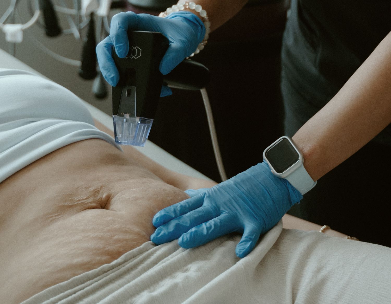 Crown Point Stretch Mark Treatment model with black hair