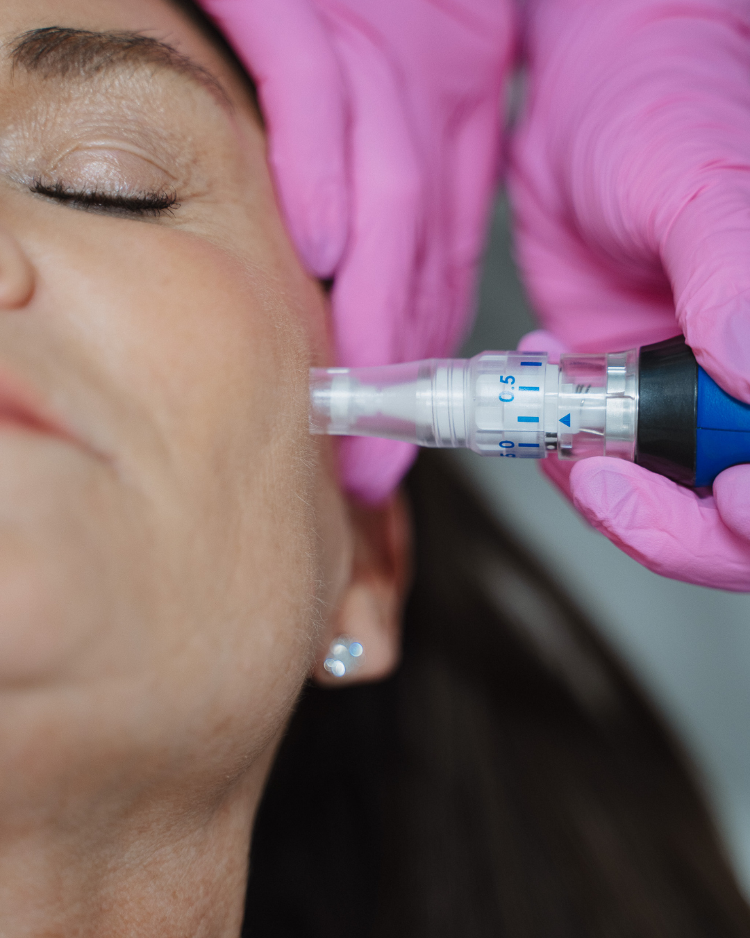 Crown Point Acne Scar Treatment model with curly hair