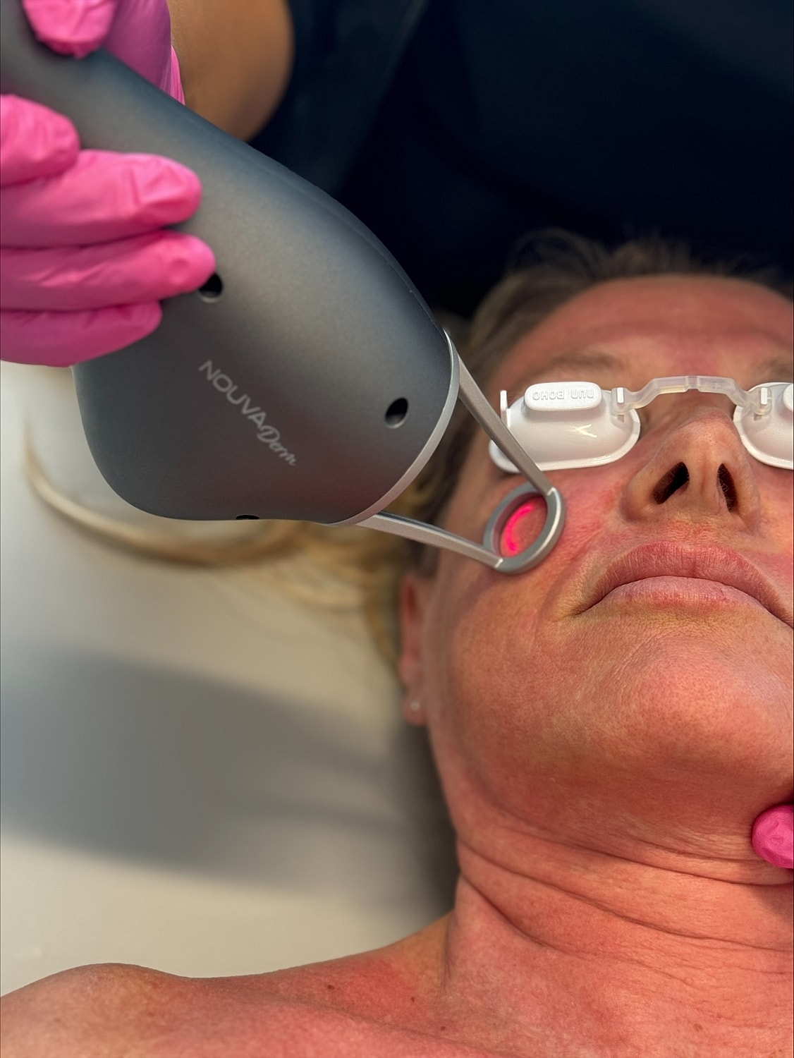 Facial treatment with laser device in progress