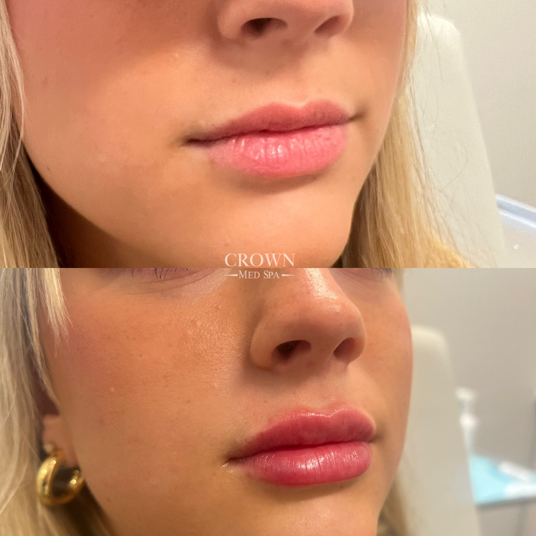 Lip Fillers Gallery Before & After