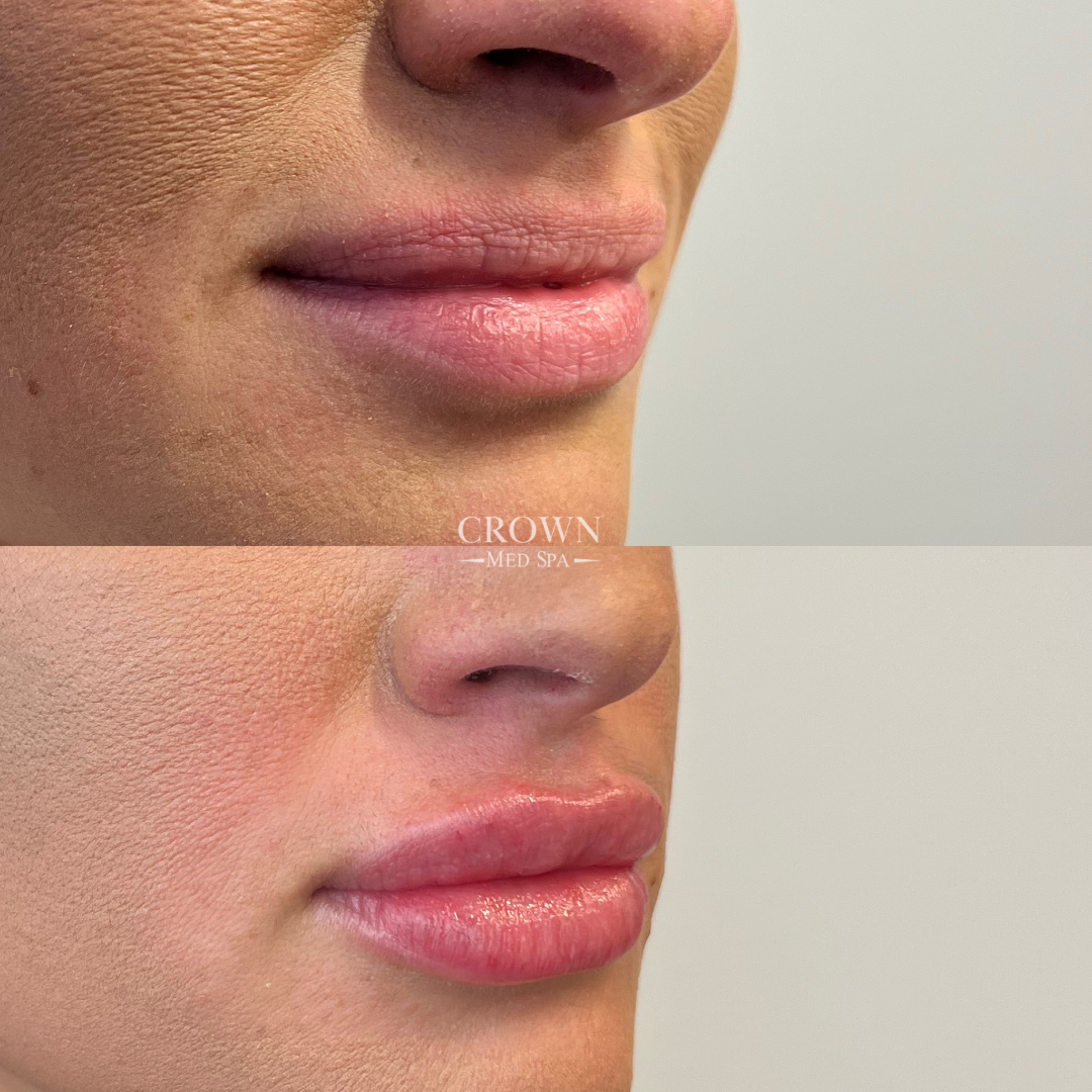 Lip Fillers Gallery Before & After