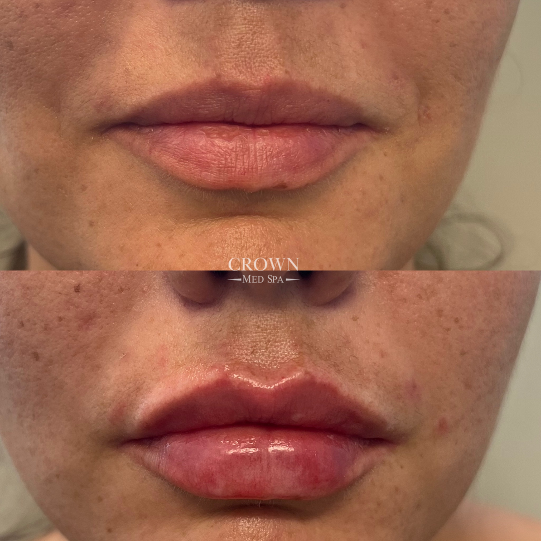 Lip Fillers Gallery Before & After