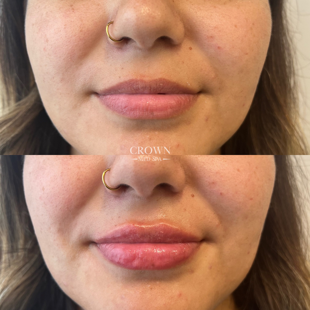 Lip Fillers Gallery Before & After